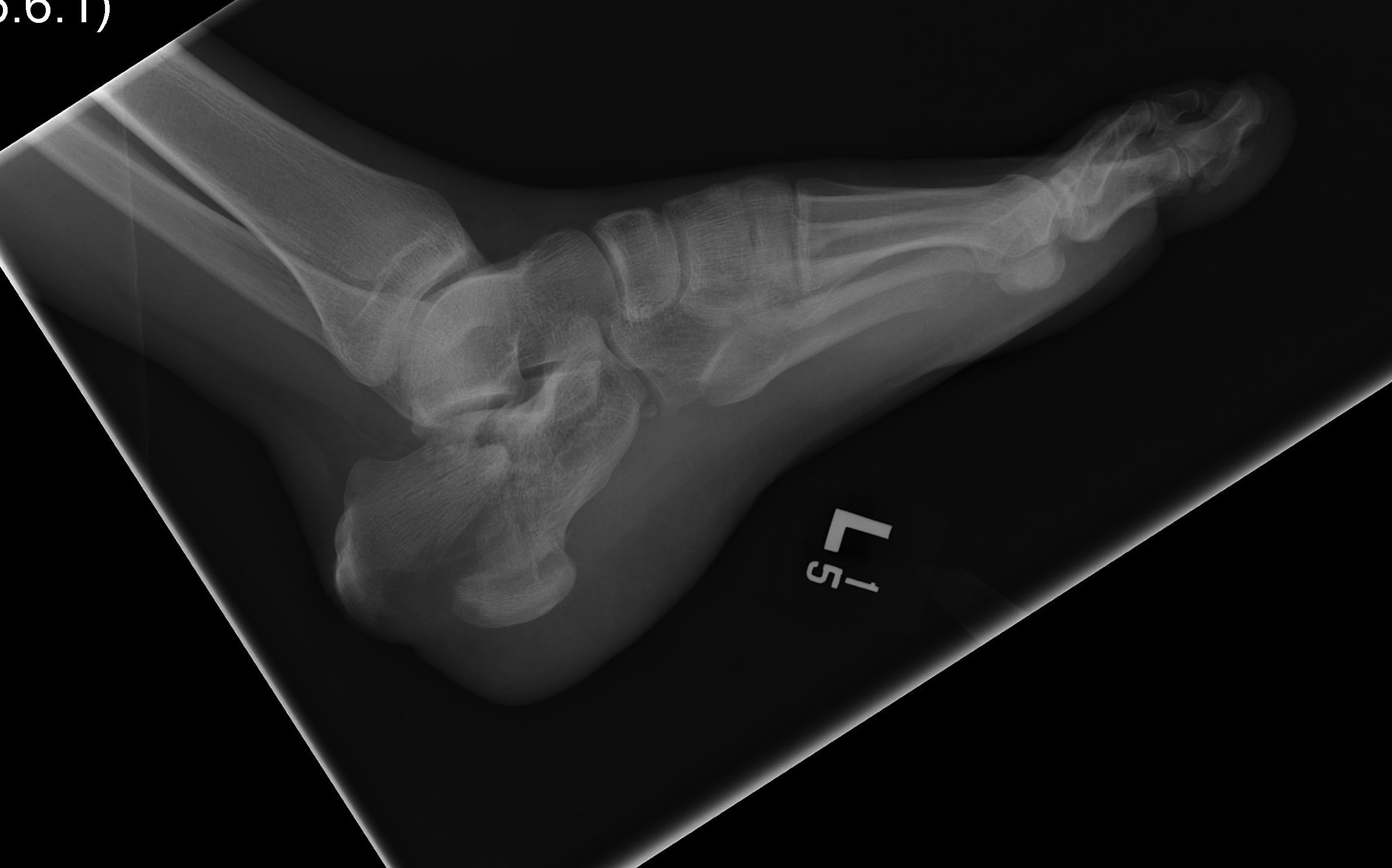 Calcaneal Fracture Tongue Type